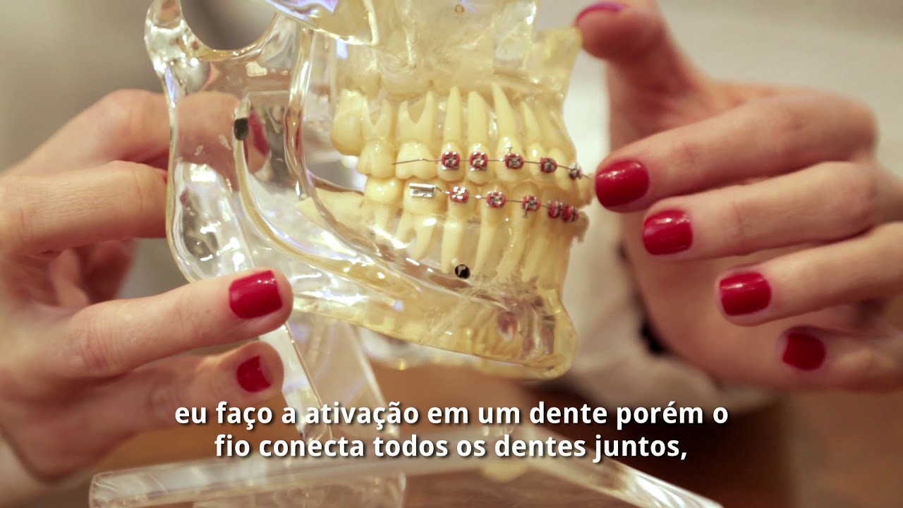 Os tratamentos com Invisalign são mais rápidos?