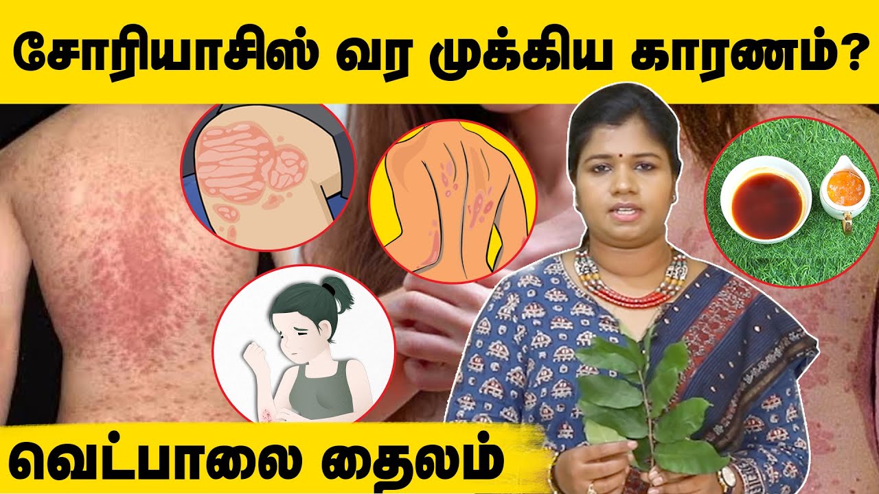 Psoriasis: ஒரே வாரத்தில் குணமாக்க ஓர் எளிய வழி - விளக்குகிறார் Dr.B Yoga Vidhya | Iyarkai Maruthuvam