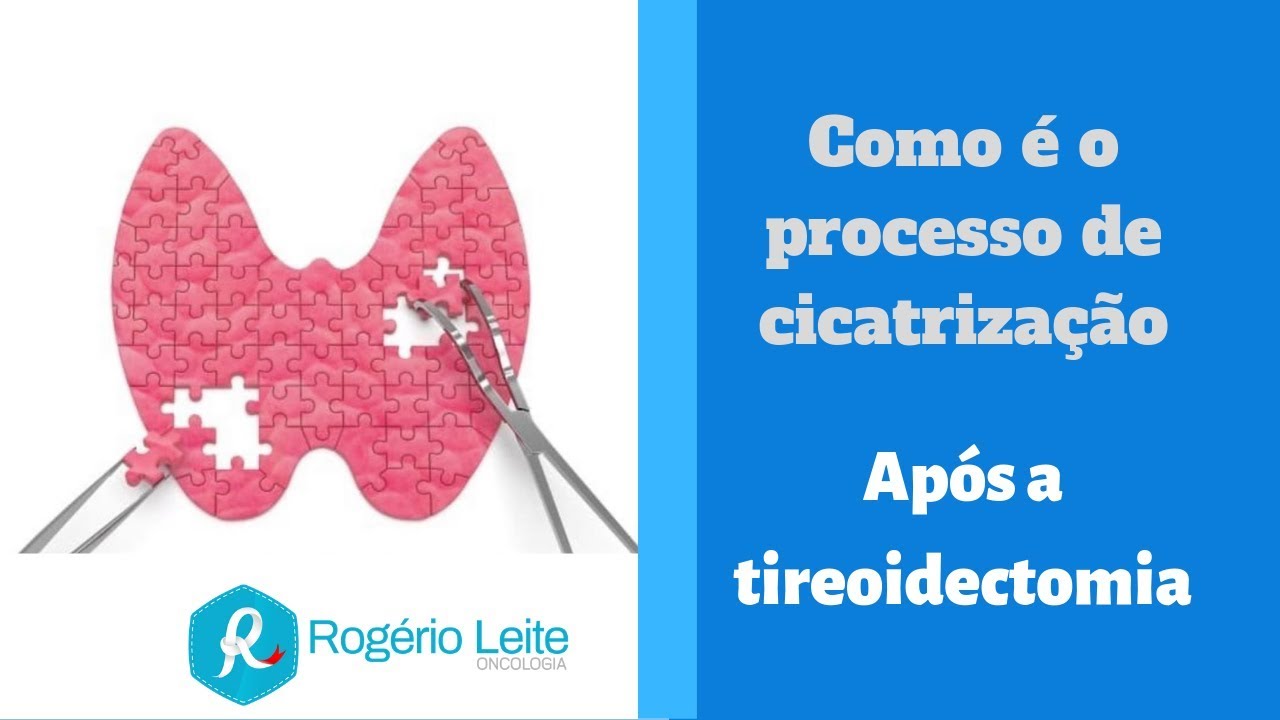 Como é o processo de cicatrização após a tireoidectomia - Dr. Rogério Leite