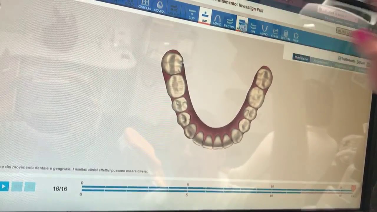 Video Invisalign ClinCheck