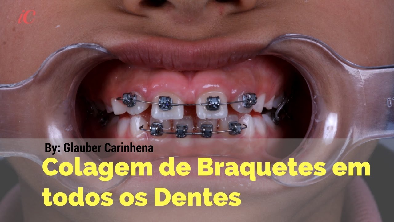 Colagem de braquetes em todos os dentes