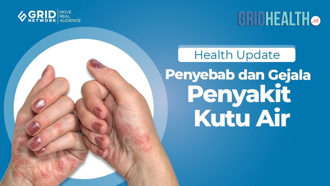 Wajib Tahu! Ini Penyebab dan Gejala Penyakit Kutu Air