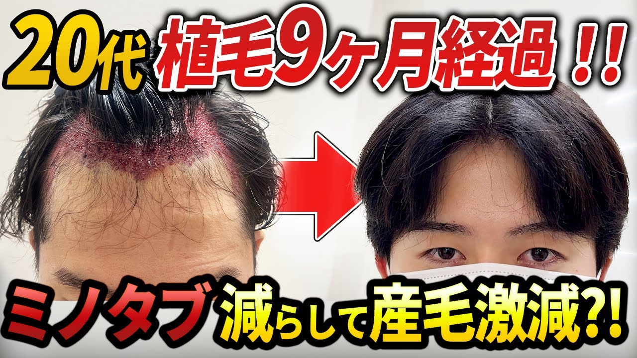 25歳植毛9ヶ月でミノタブ減らしたらヤバかった アスク井上クリニック