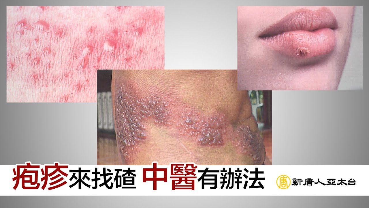 得了『疱疹』是多麼痛的領悟 中醫治療有一套 | 談古論今話中醫(452)