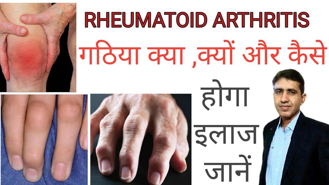 गठिया | Rheumatoid Arthritis Causes and Treatment | आमवात | In Hindi | Homeopathy Treatment