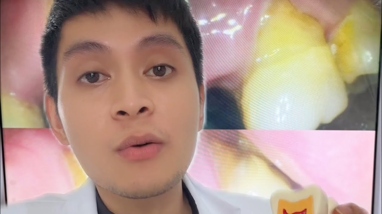 ILAN SA MGA DAHILAN KUNG BAKIT NAKAKARANAS NG MATINDING PANGINGILO KAHIT NAGSISIPILYO NAMAN