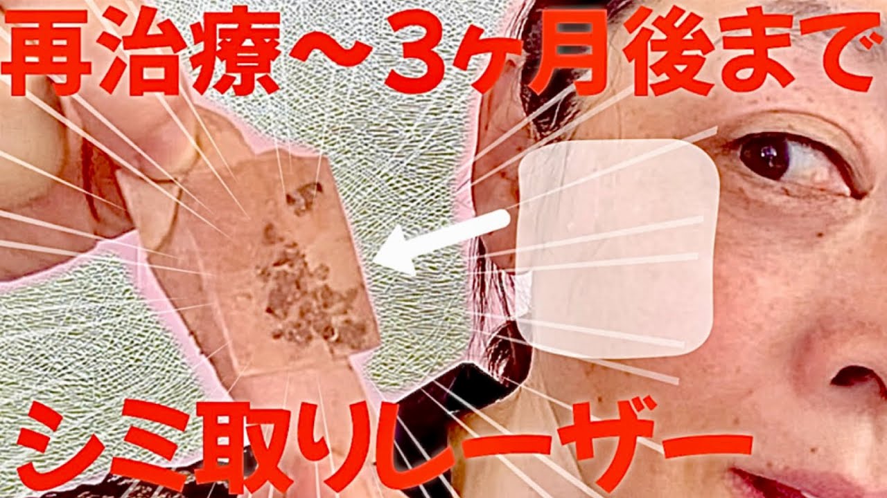 【シミ治療】シミ復活？肝斑？再治療〜3ヶ月後の経過をお見せします！