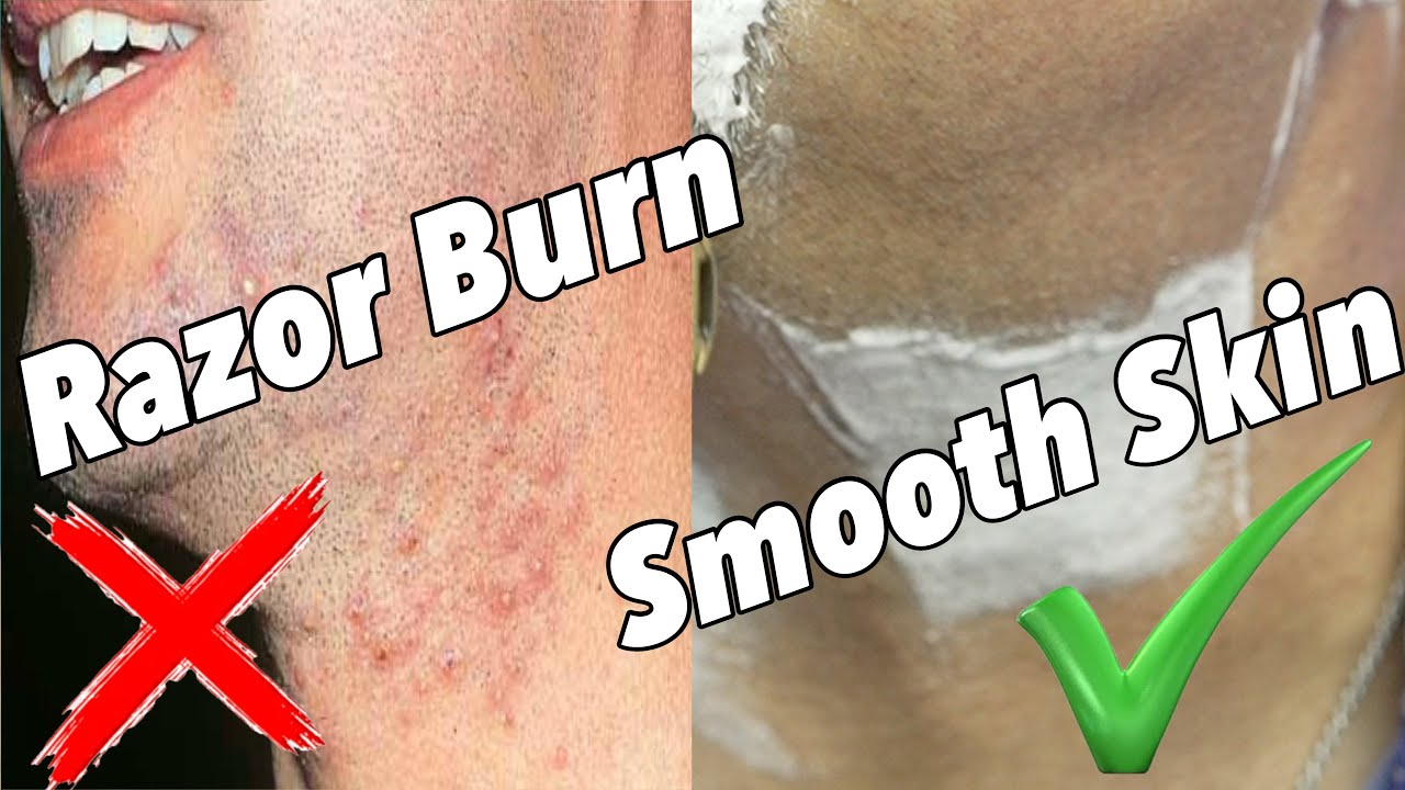 I Eliminated Ingrown Hairs Using This Simple Routine