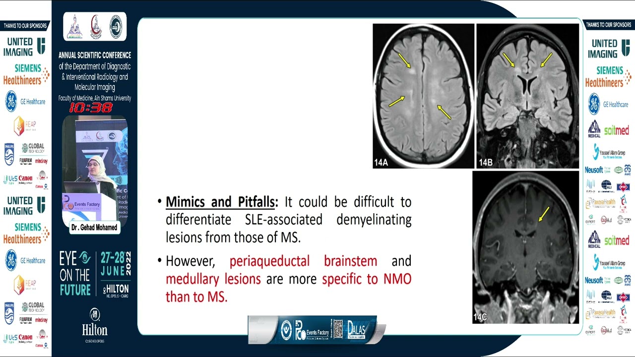 Imaging of SLE Neurological Manifestations