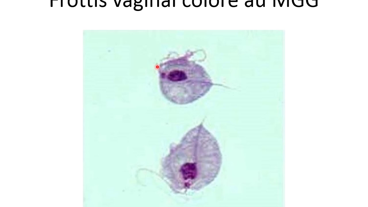 Trichomonas vaginalis