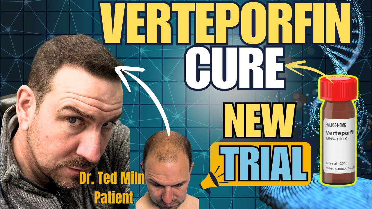 Verteporfin Hair Loss Cure Trial To Start 2025- Dr. Ted Miln UK