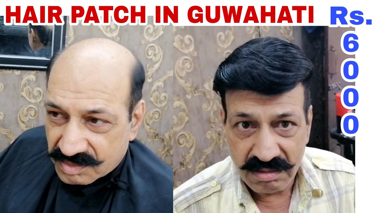 Hair Patch In Guwahati | Non surgical Hair Replacement Centre In Assam | Hair patch for Mens