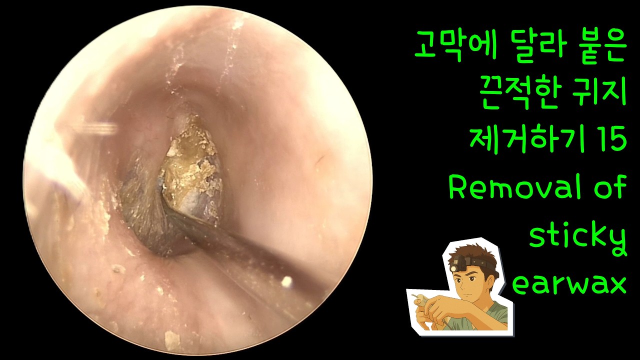 고막에 달라 붙은 끈적한 귀지 제거하기 15 (Removal of sticky earwax)