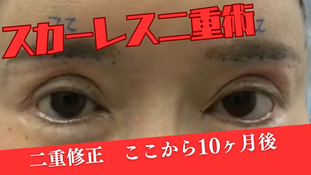スカーレスして１０か月