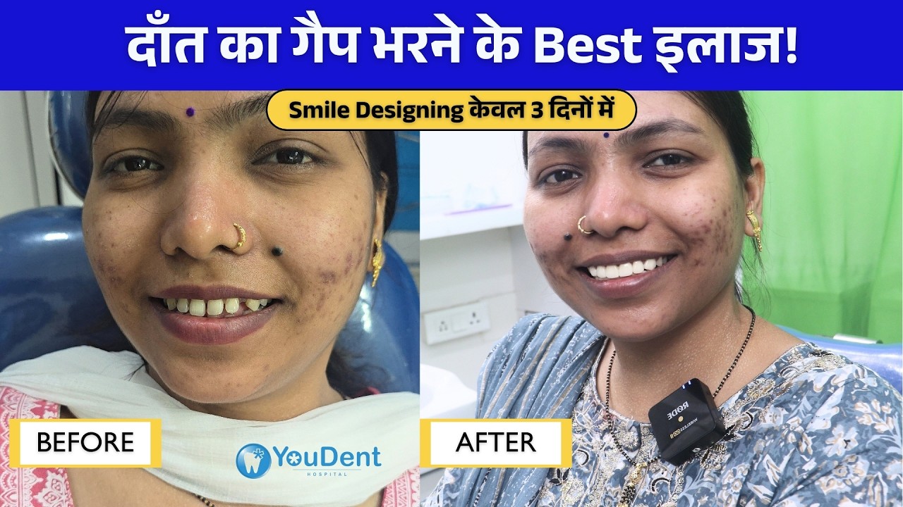 अब नहीं दिखेगा दाँतों के बीच का गैप! Smile Designing से पाएँ बॉलीवुड जैसी परफेक्ट स्माइल