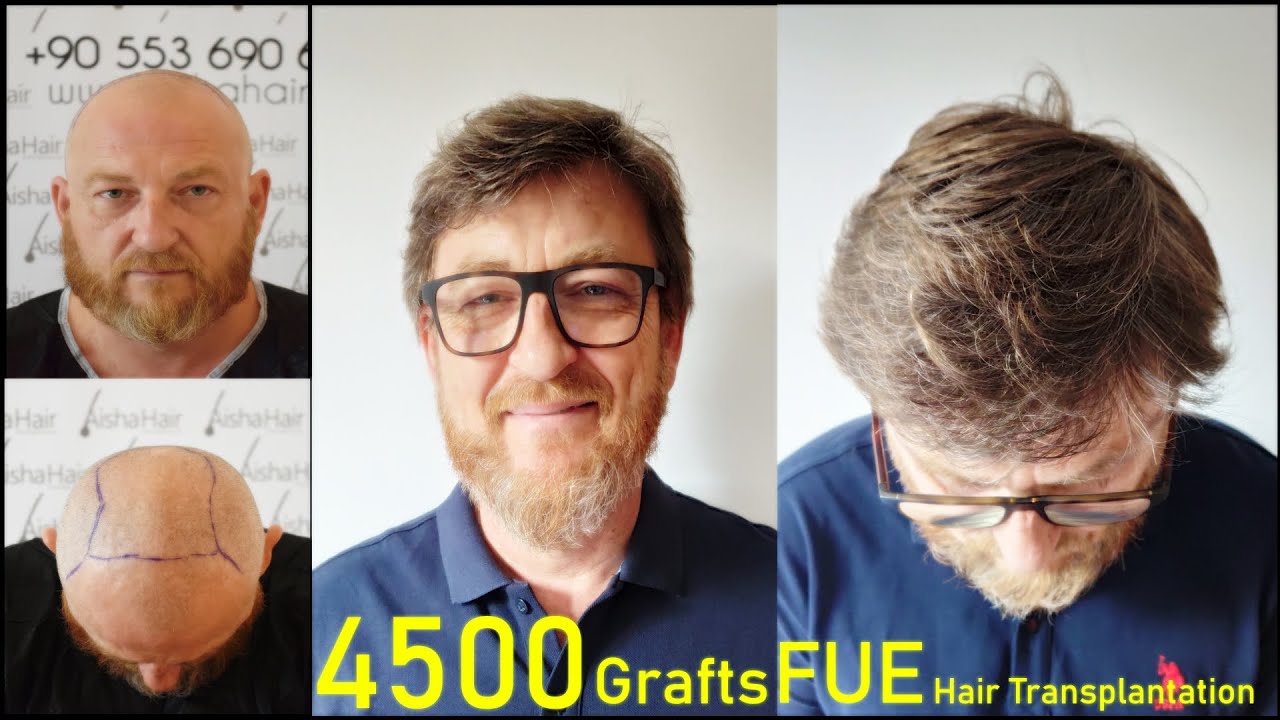 Full Density Hair Transplant / Injerto Capilar Densidad Completa