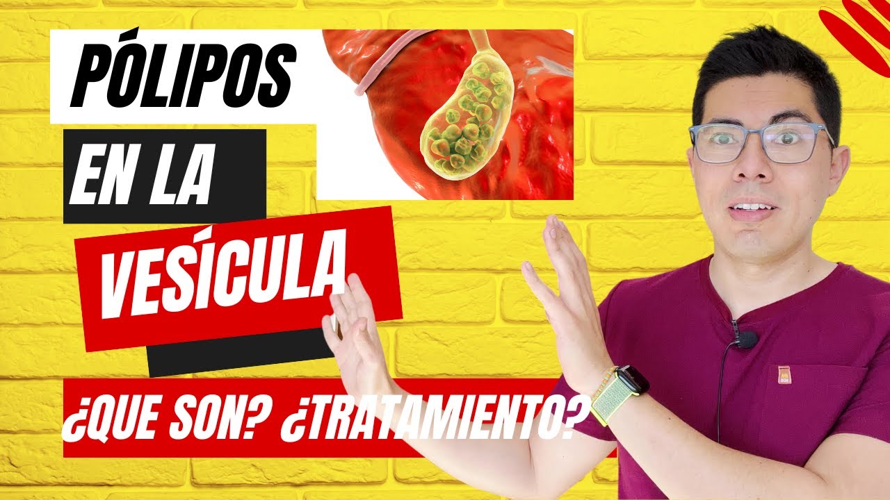 pólipos en la vesícula| ¿que son? causas, tratamiento