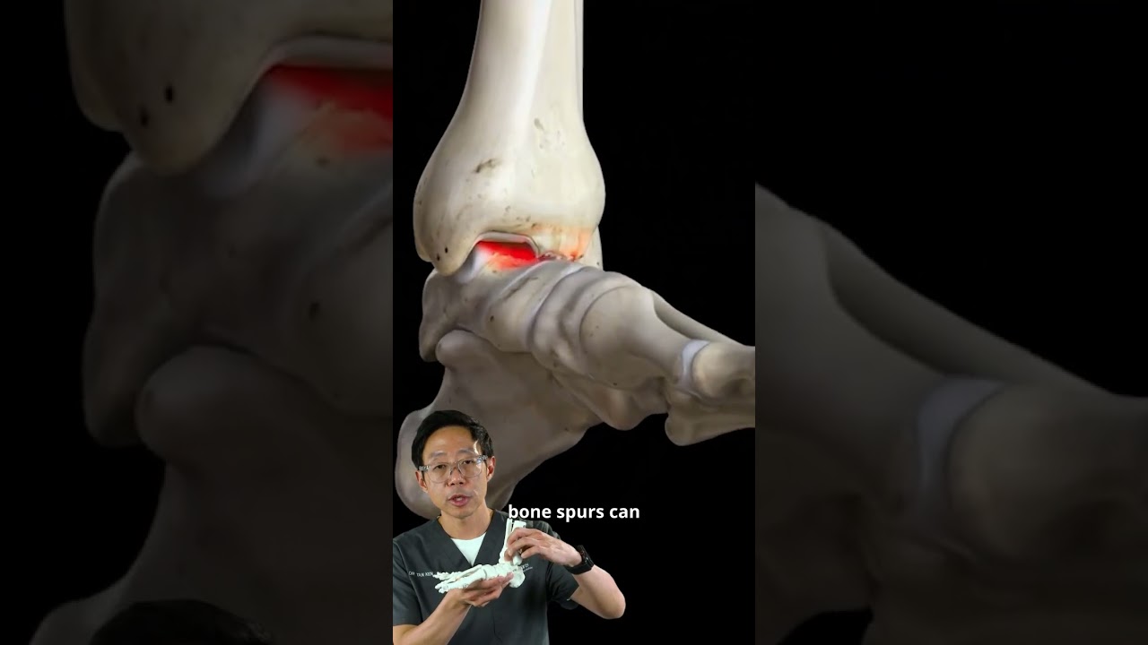 Dr Tan Ken Jin Explains Ankle Bone Spurs | #MCAShorts