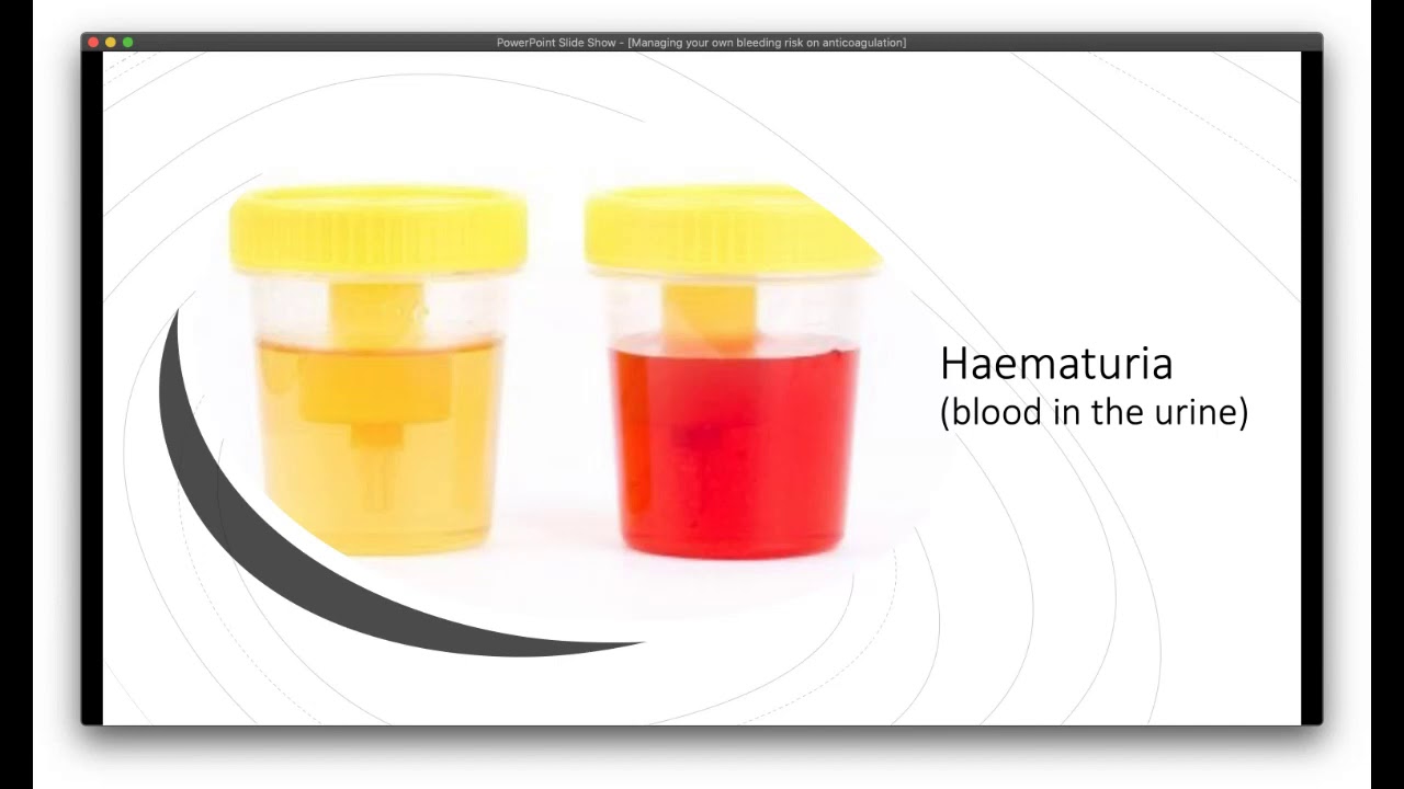 Webinar - Bleeding Risk on Anticoagulation Meds with  Prof  Kerstin de Wit