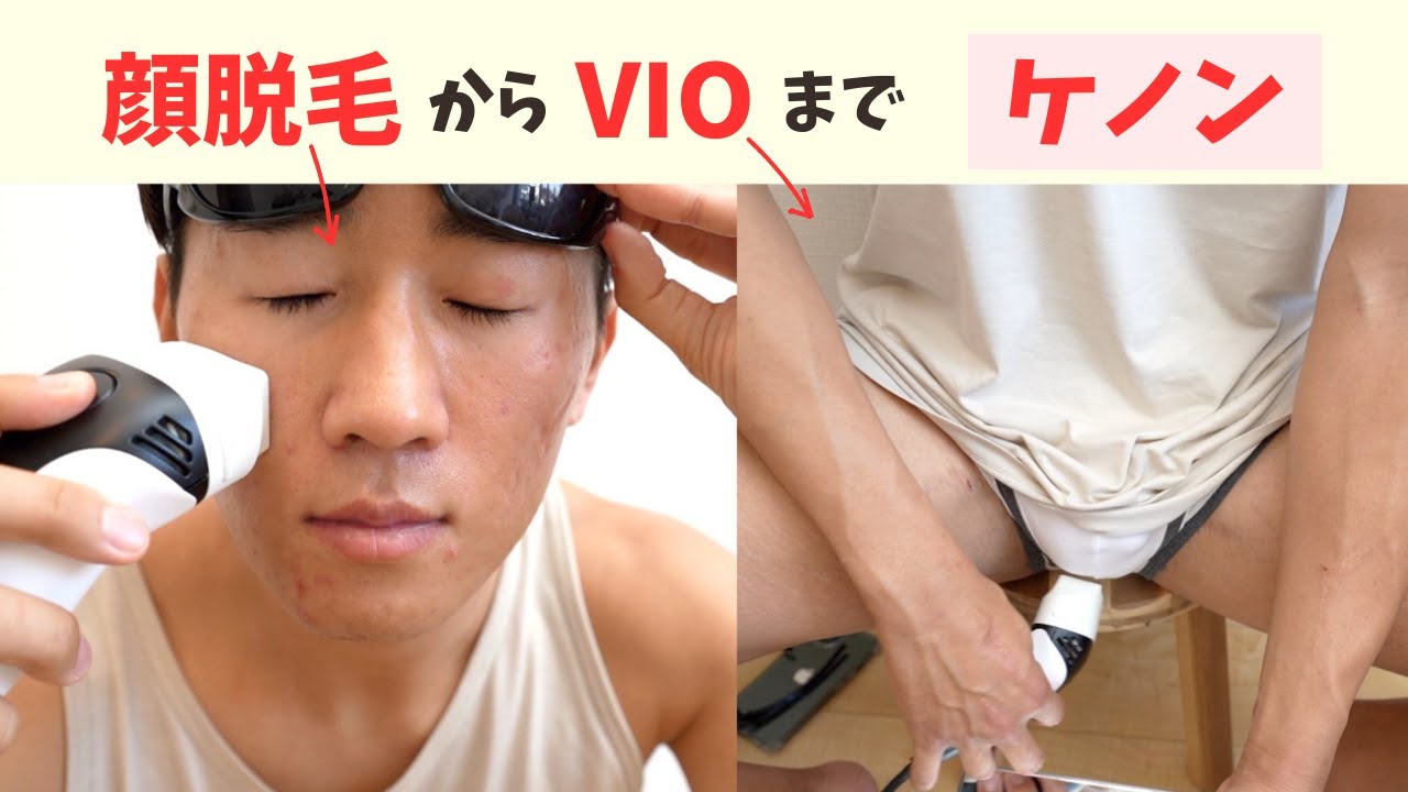 【光脱毛器No 1】ケノンの使い方と知ってほしいコツ！VIOから顔脱毛まで【再放送】