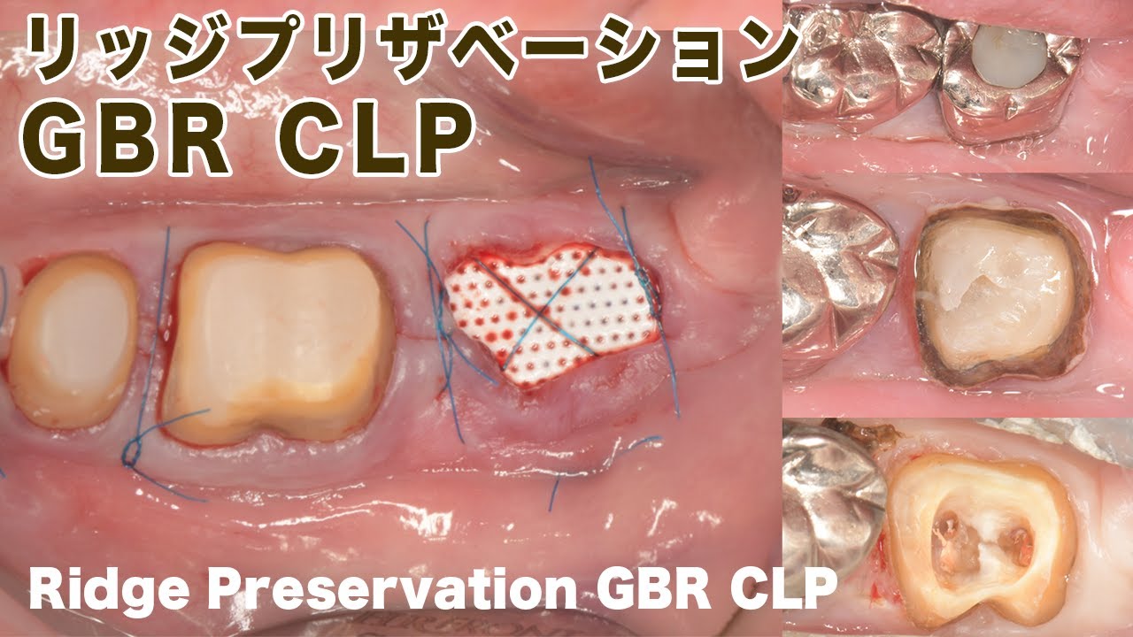 リッジプリザベーションGBR【CLP】Ridge Preservation GBR CLP