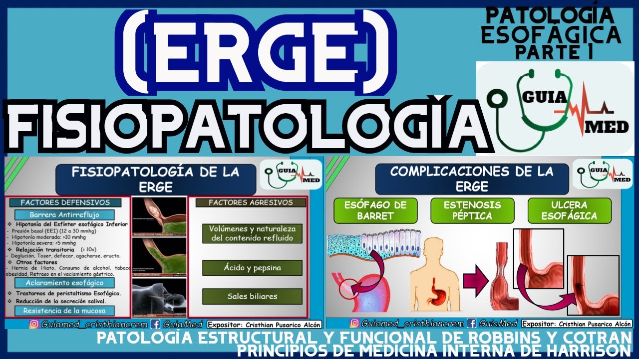 ENFERMEDAD POR REFLUJO GASTROESOFÁGICO FISIOPATOLOGÍA | GuiaMed