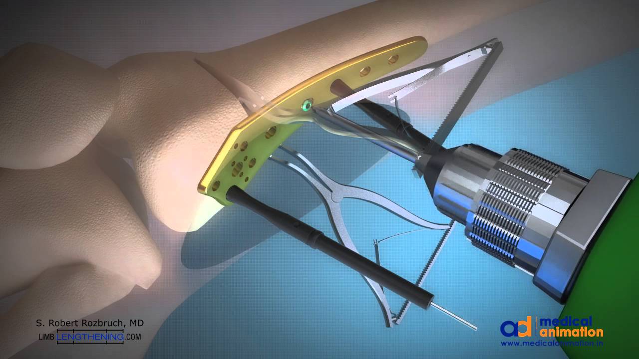 Distal Femoral Osteotomy Animation