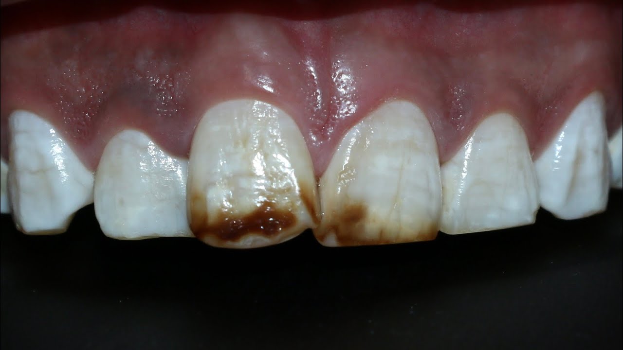 Tratamiento fluorosis dental / antivet