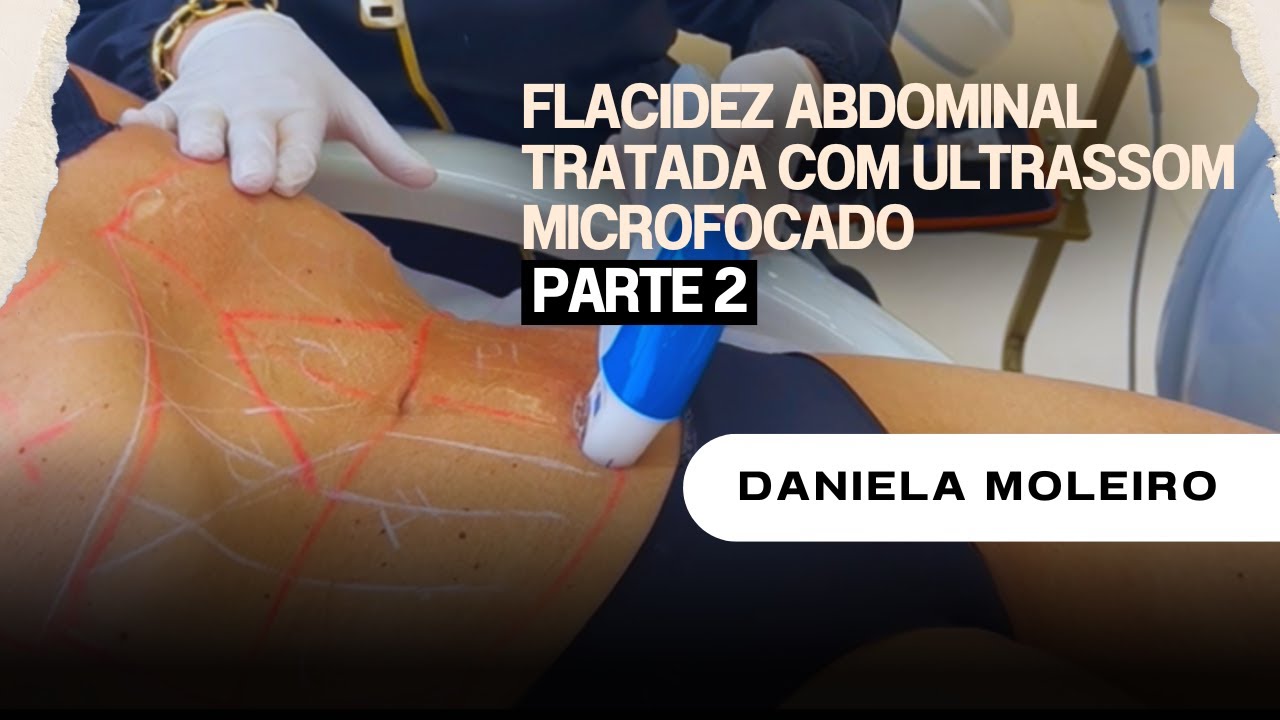 O FIM DO UMBIGO TRISTE - PARTE 2