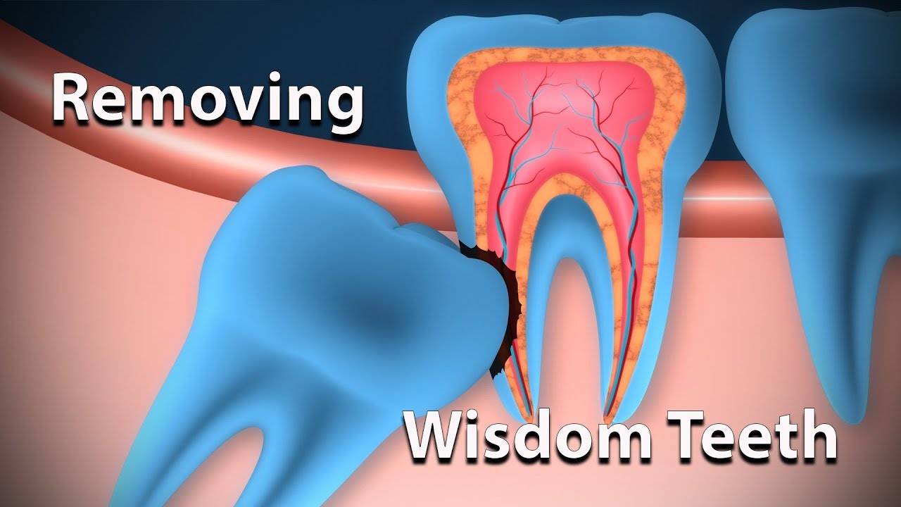 Why an oral surgeon should remove your wisdom teeth.