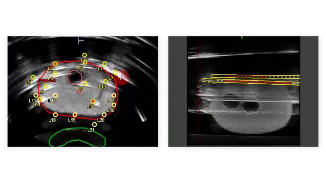 Real-time Prostate Solutions for treating prostate cancer with brachytherapy