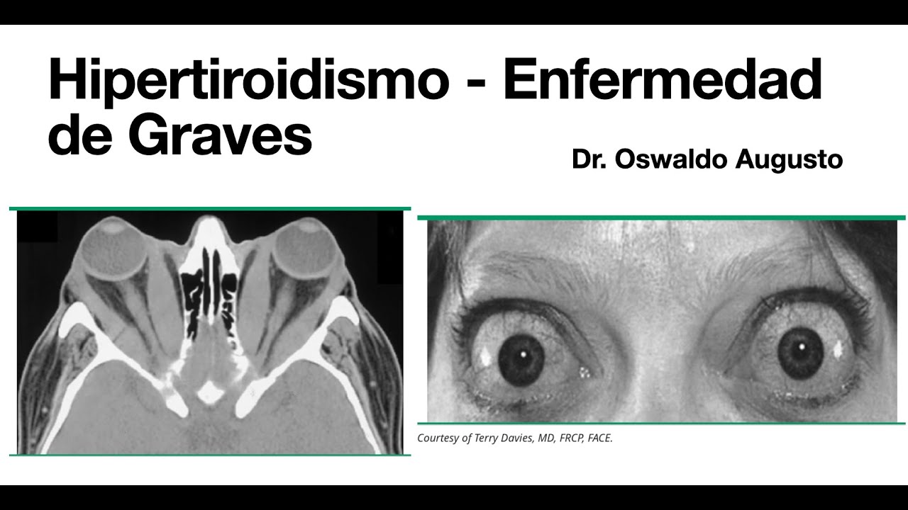 Hipertiroidismo - Enfermedad de Graves - Nódulo tóxico - Endocrinología
