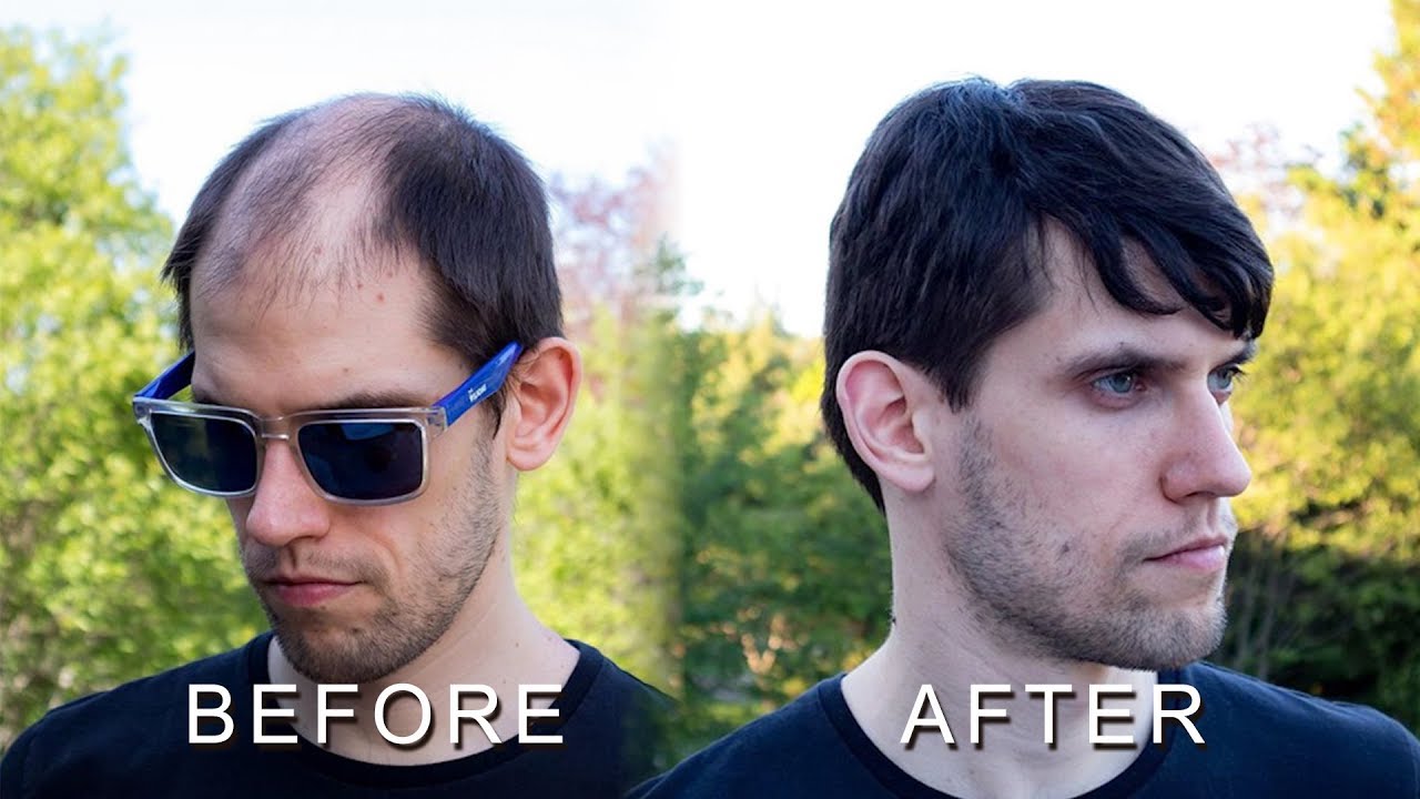 INSTALLATION-HAIR REPLACEMENT SYSTEM FOR MEN
