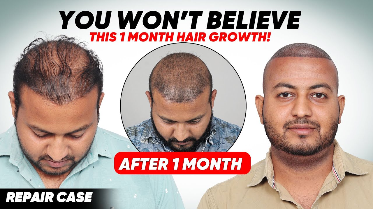 Hair Transplant in Hyderabad (HX-TMVN) | Best Results & Cost of Hair Transplant in Hyderabad
