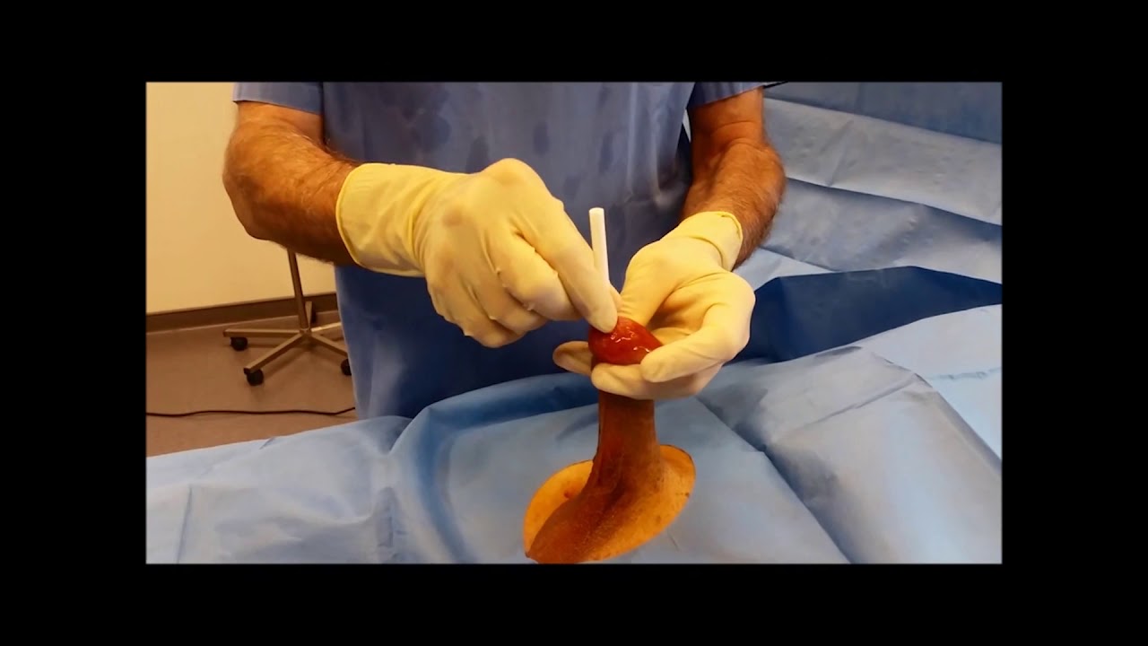 AUA2020 V08-01: Acute or chronic urine retention in males