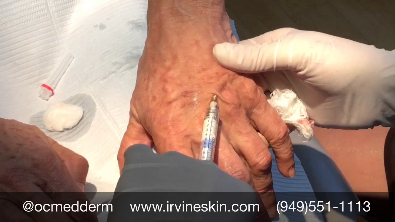 Lose 20 Years In Minutes With Radiesse Hand Rejuvenation