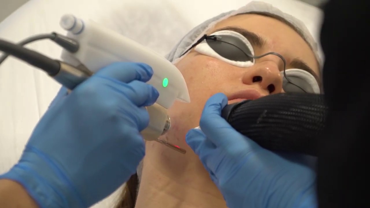 Dermatologas atsako: ką daryti susidūrus su aknės bėrimais? ǀ Sana Juna klinika