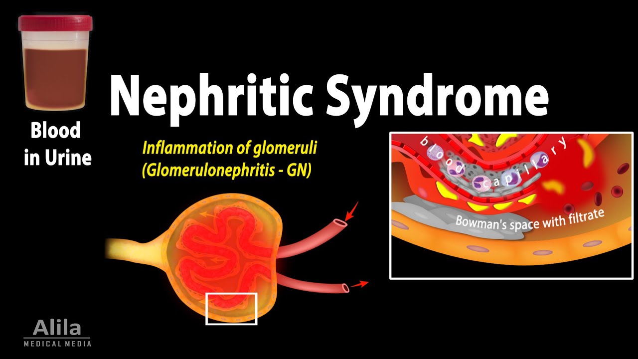 Nephritic Syndrome: Symptoms, Pathophysiology, Causes, Diagnosis and Treatments, Animation.