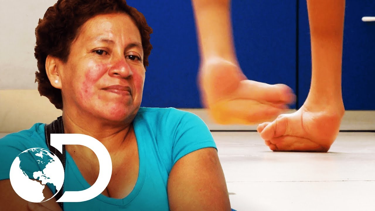 Cirug&iacute;a para enderezar los pies | Mi cuerpo, mi desaf&iacute;o | Discovery Latinoam&eacute;rica