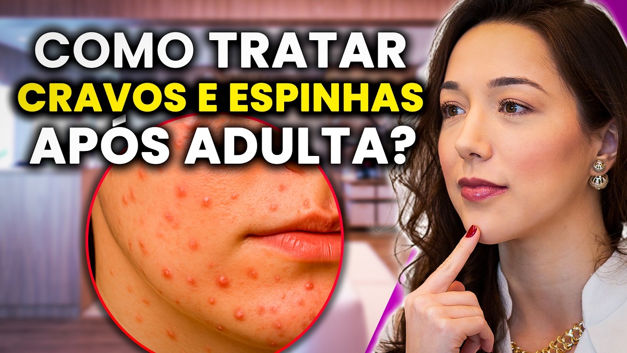 ACNE DA MULHER ADULTA: o que é, tratamentos e como controlar de vez I Dermato explica!