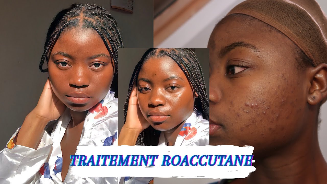 BILAN 1 AN APRÈS TRAITEMENT ROACCUTANE/CURACNÉ/ACCUTANE TREATMENT PEAU NOIRE/DARK SKIN