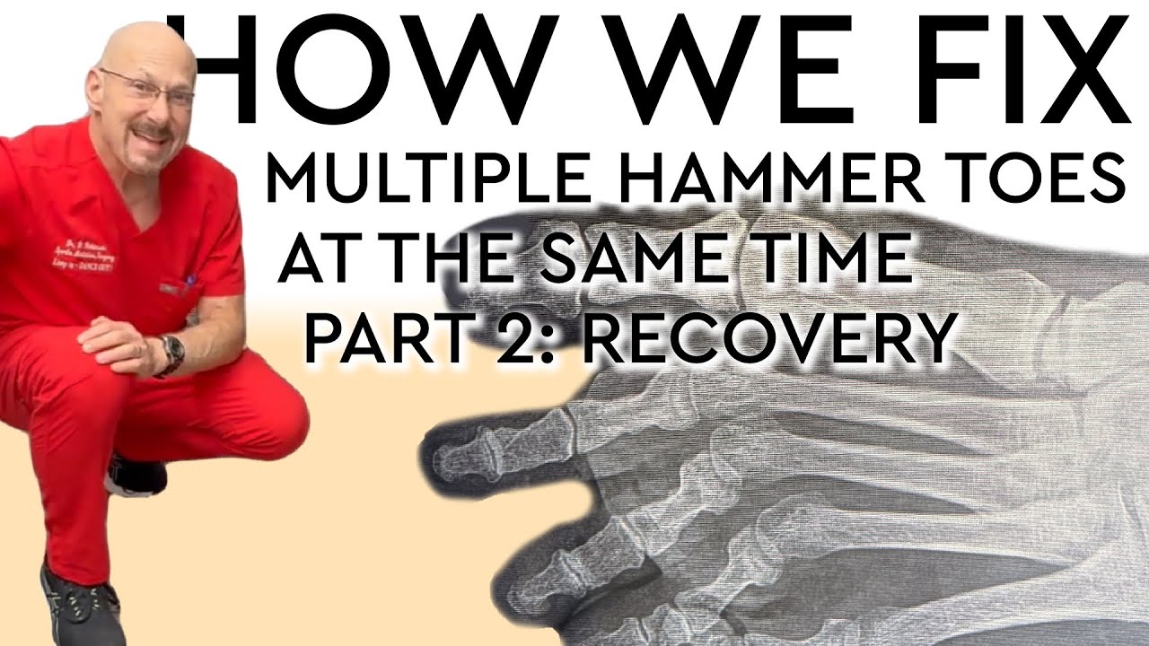 How We Fix Multiple Hammer Toes At Once Part 2