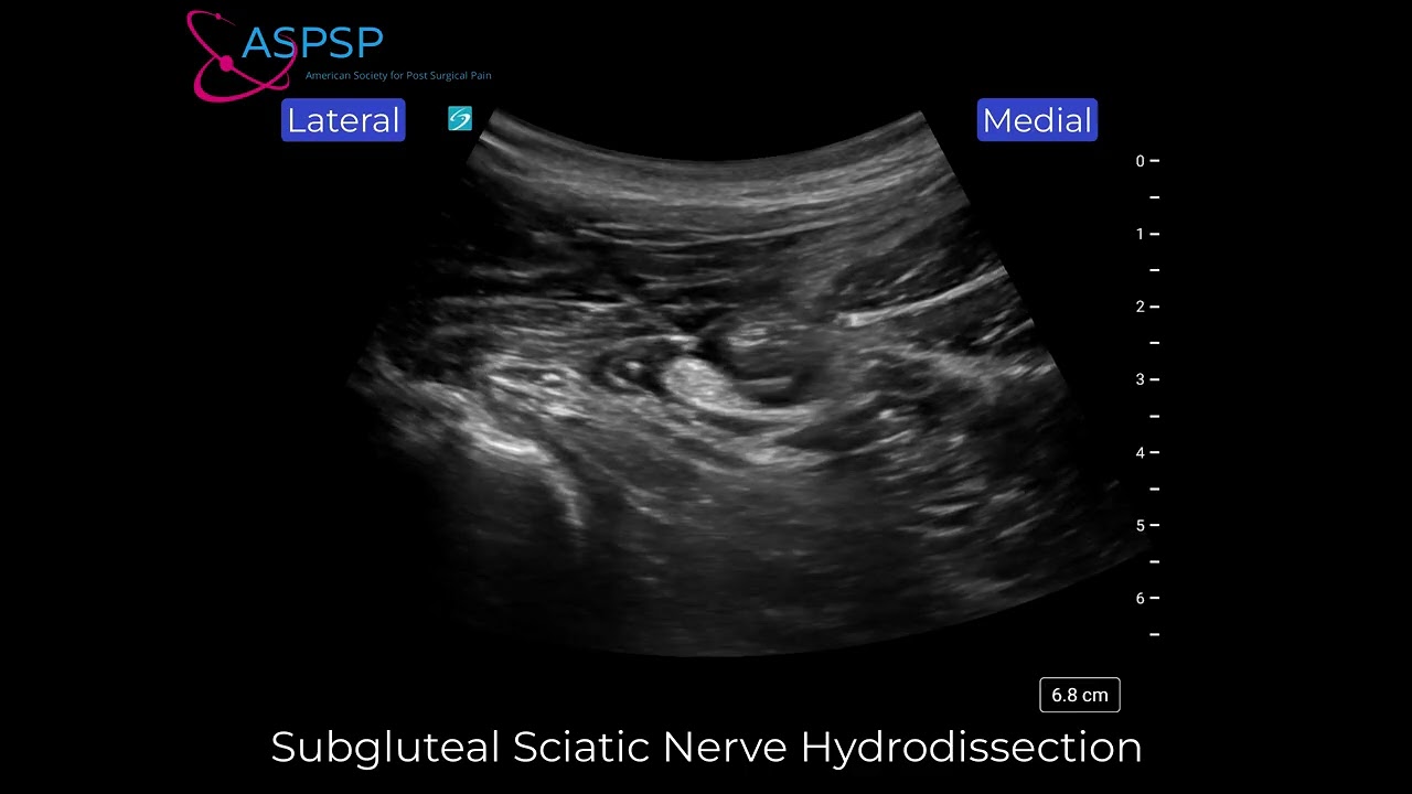 Subgluteal Sciatic Nerve Hydrodissection