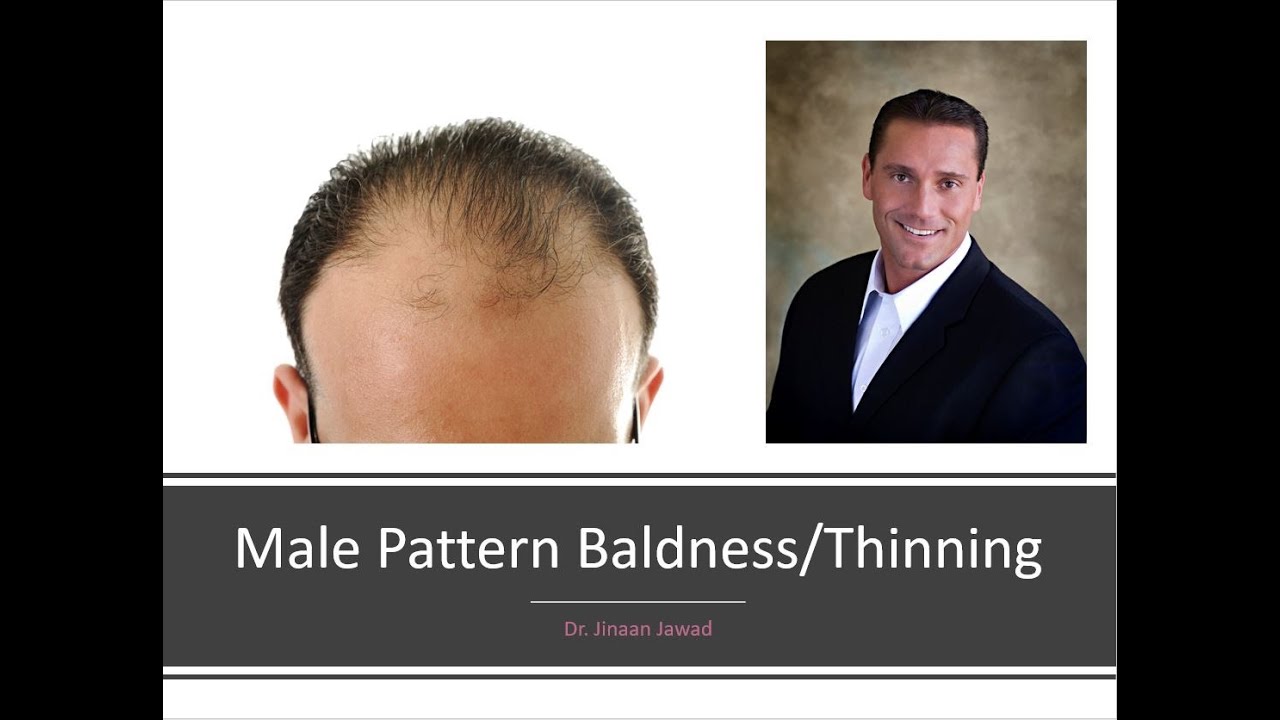 What Causes Male Pattern Baldness?