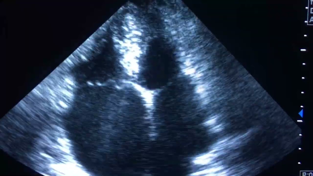 Spontaneous Echo Contrast in Heart: Do They Have Risk of Thromboemboli?