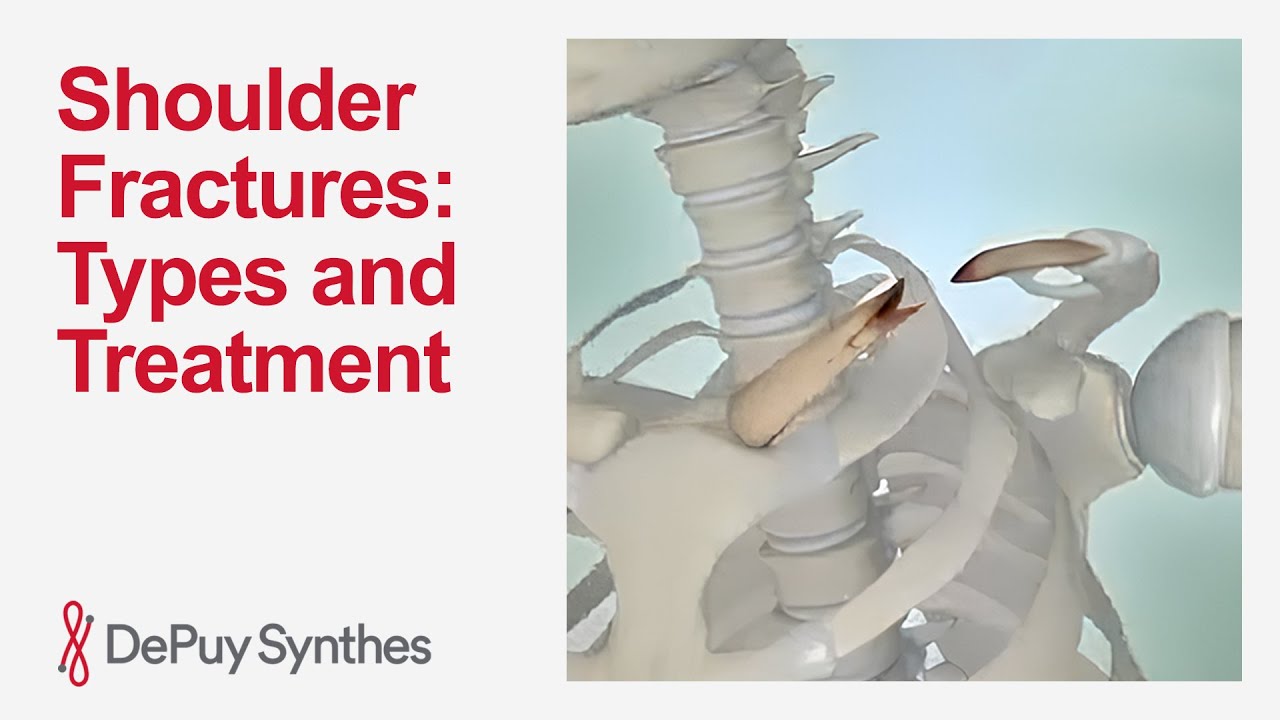 What You Need to Know About Shoulder Fractures and Treatment | DePuy Synthes