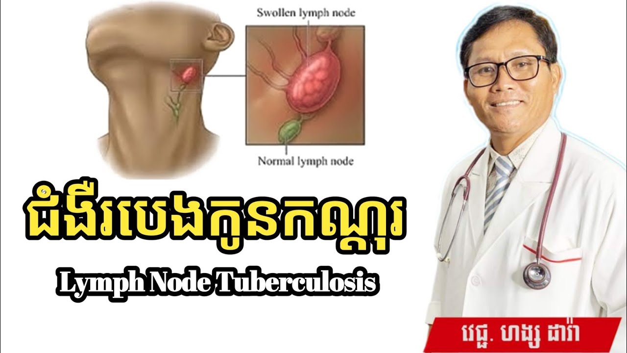 ជំងឺរបេងកូនកណ្តុរ Lymph Node Tuberculosis  | វេជ្ជ. ហង្ស ដារ៉ា | ចំណេះដឹងសុខភាព | success knowledge