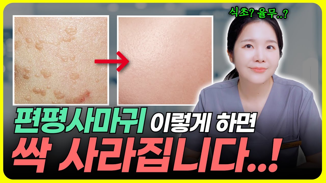 편평사마귀 방치하면 큰일나요 ⚠️ 홈케어·제거법·자연치유 총정리