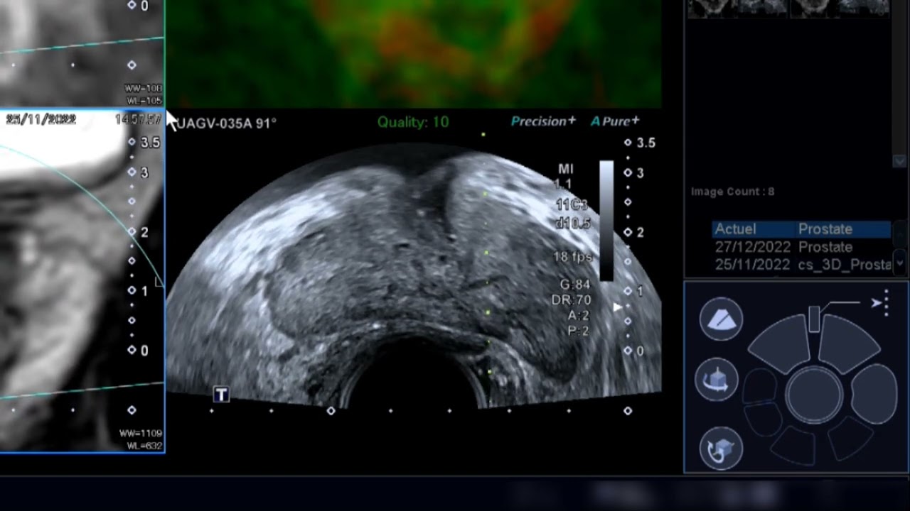 Transrectal MR/US fusion biopsy of an anterior prostate cancer