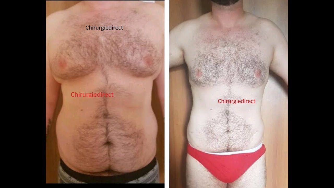 Chirurgie esthetique Tunisie: Liposuccion sept 2017